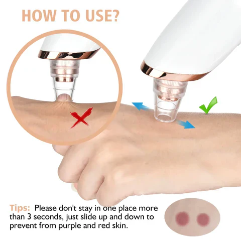 MULTI-FUNCTIONAL BLACKHEAD REMOVER VACUUM TOOL FOR PORE CLEANSING AND ACNE TREATMENT - Image 16